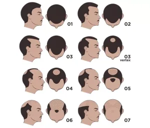 Hair tattoo MHP Micro HaarPigmentatie Haarverlies bij mannen