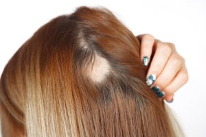 Alopecia Bij Vrouwen Hair Tattoo MHP Micro Haarpigmentatie