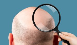 Alopecia MHP Hair Tattoo Micro Haarpigmentatie