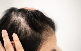 Alopecia bij Vrouwen MHP Hair Tattoo