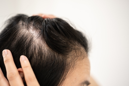 Alopecia bij Vrouwen MHP Hair Tattoo