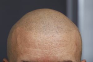 Micro Haarpigmentatie Hair Tattoo MHP