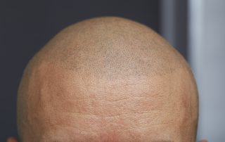 Micro Haarpigmentatie Hair Tattoo MHP